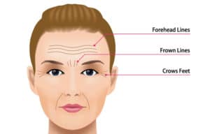 Botox Improves Crow&#8217;s Feet Lines