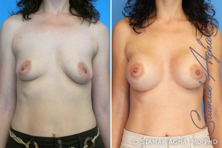 Breast Augmentation