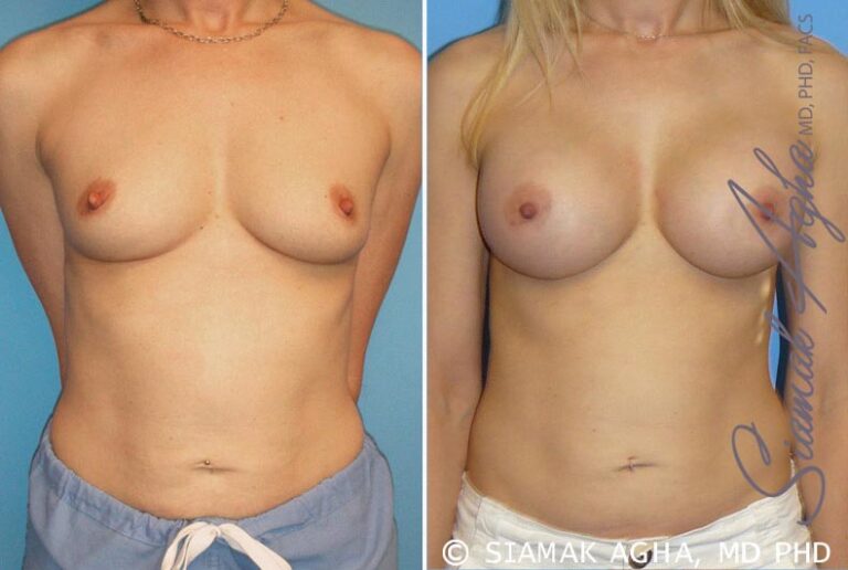 Breast Augmentation