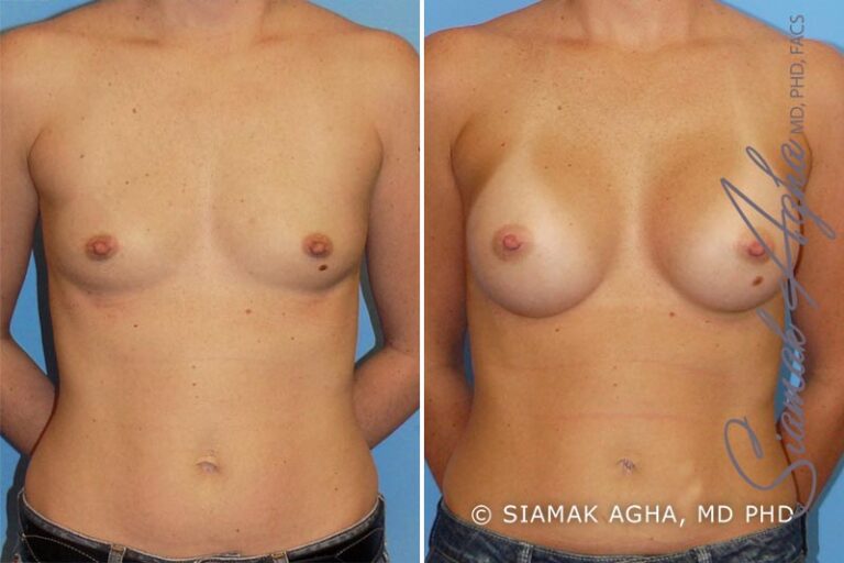 Breast Augmentation