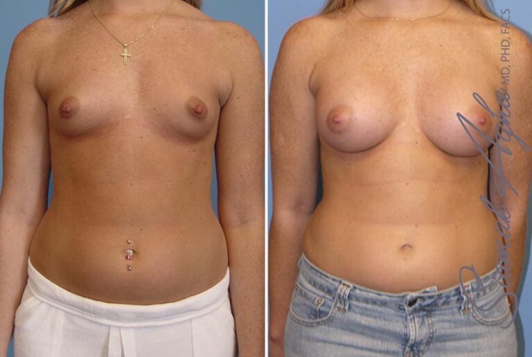 Breast Augmentation