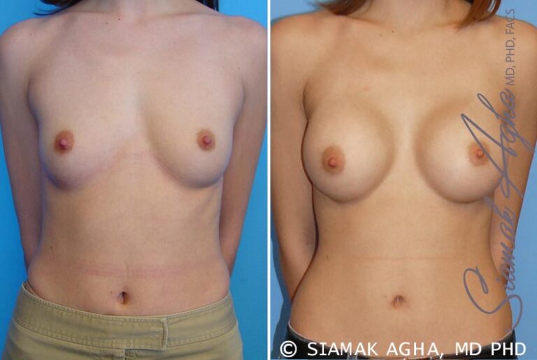 Breast Augmentation