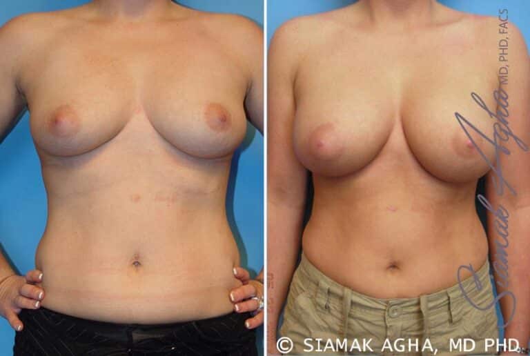 Breast Augmentation