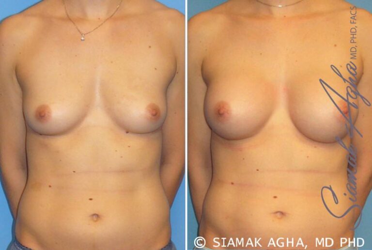 Breast Augmentation