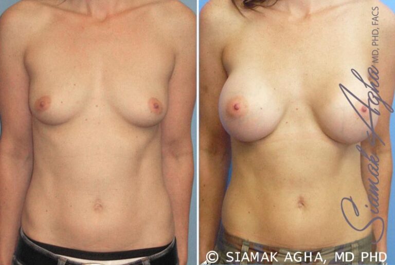 Breast Augmentation