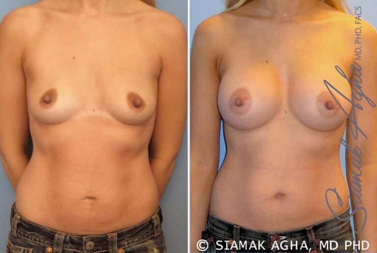 Breast Augmentation