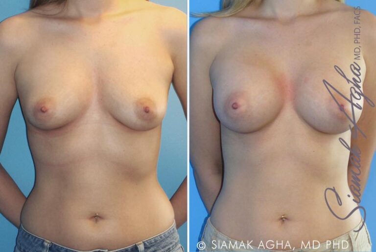 Breast Augmentation