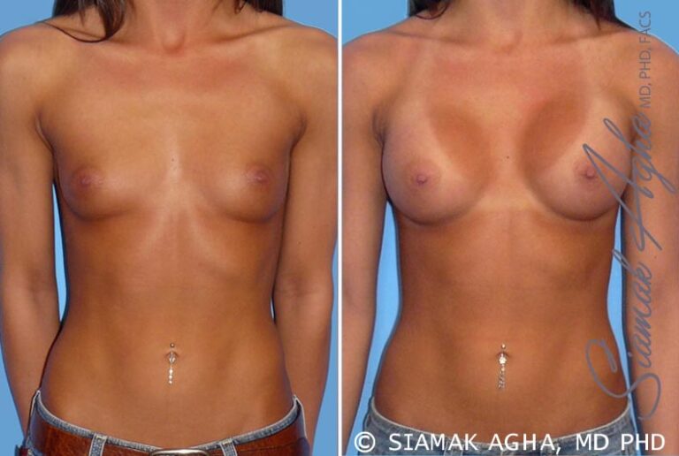 Breast Augmentation