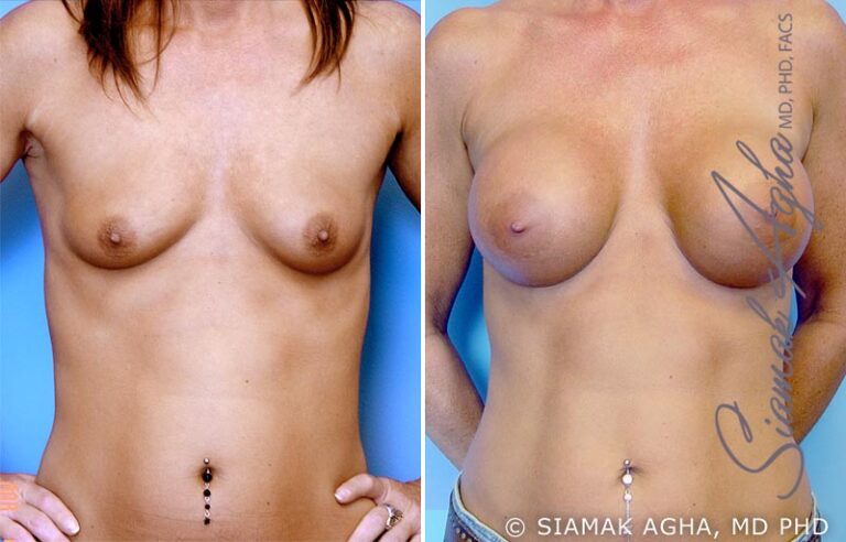 Breast Augmentation