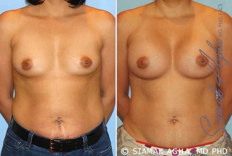 Breast Augmentation