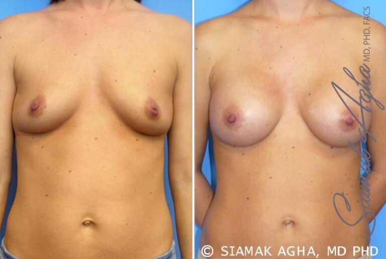 Breast Augmentation