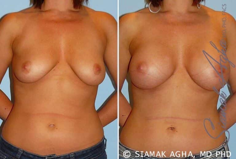 Breast Augmentation