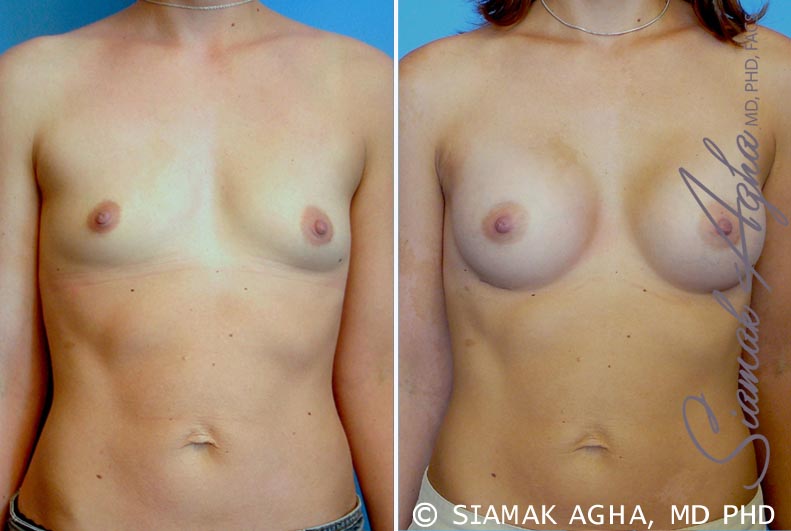 Breast Augmentation