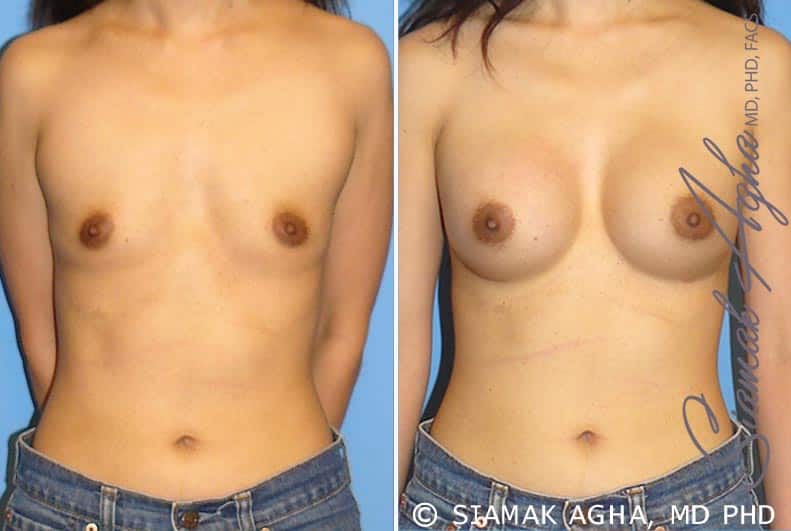 Breast Augmentation