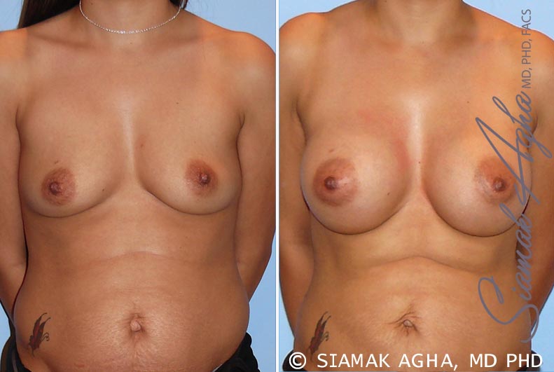 Breast Augmentation