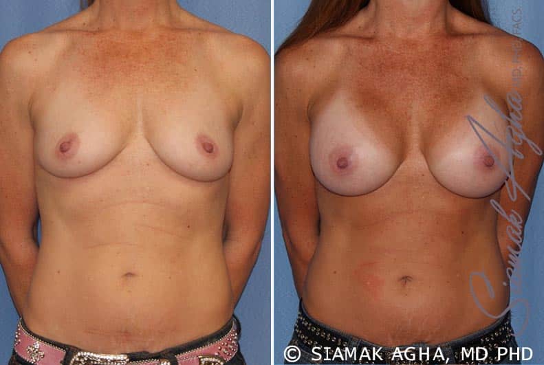 Breast Augmentation