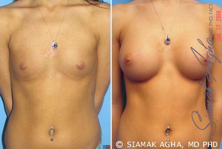 Breast Augmentation