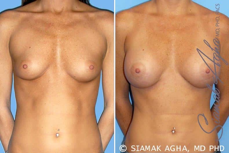 Breast Augmentation