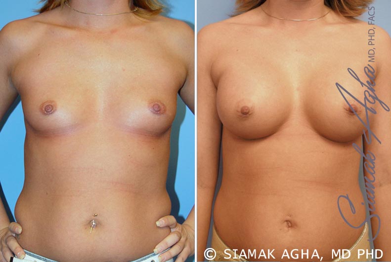 Breast Augmentation