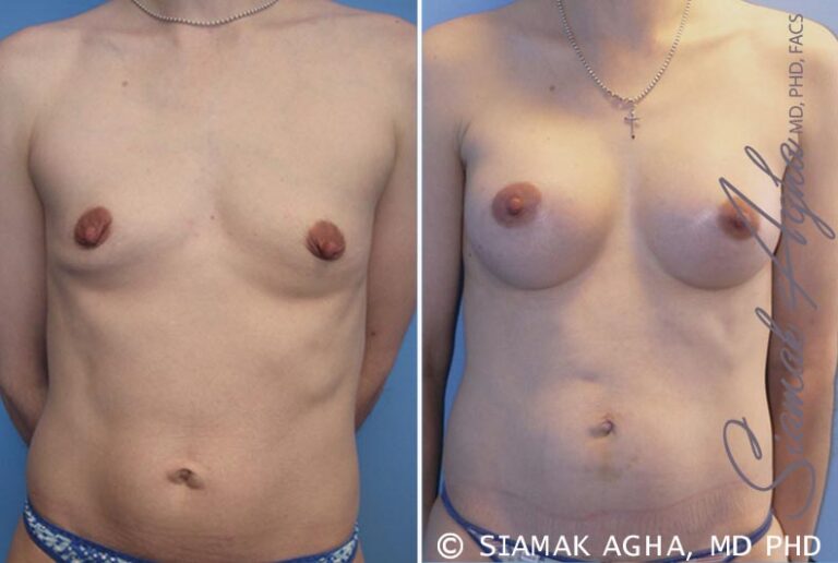 Breast Augmentation