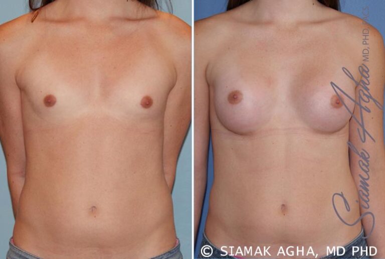 Breast Augmentation