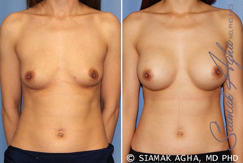 Breast Augmentation