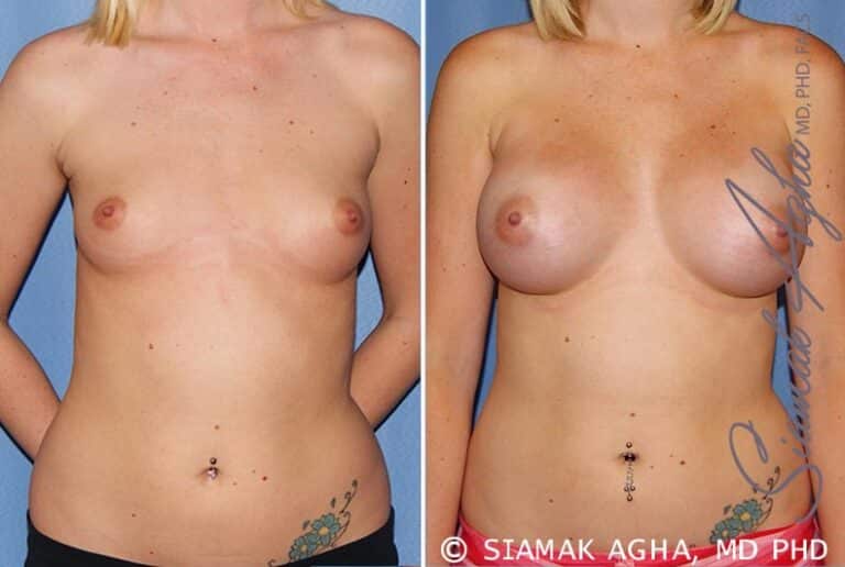 Breast Augmentation