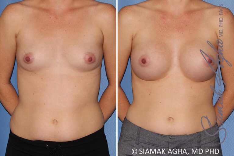 Breast Augmentation