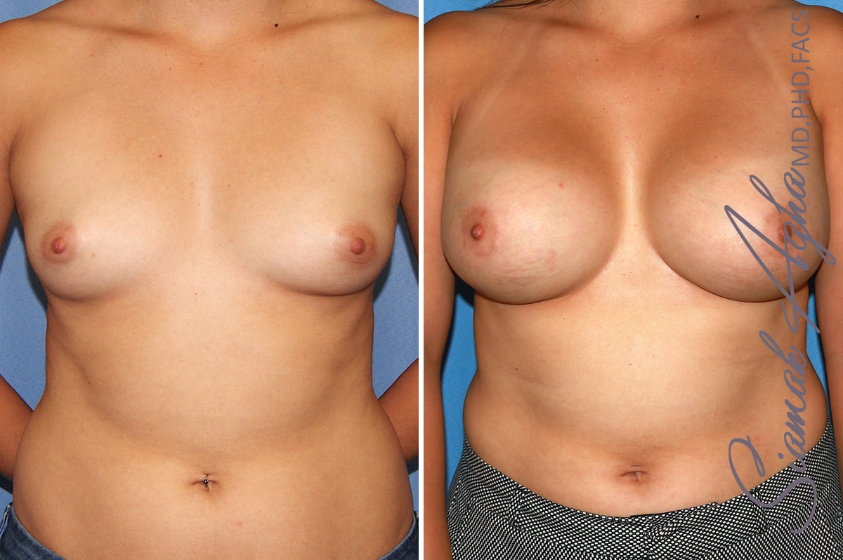 Breast Augmentation