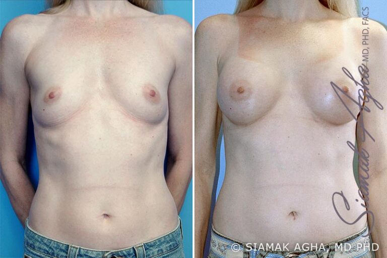 Breast Augmentation