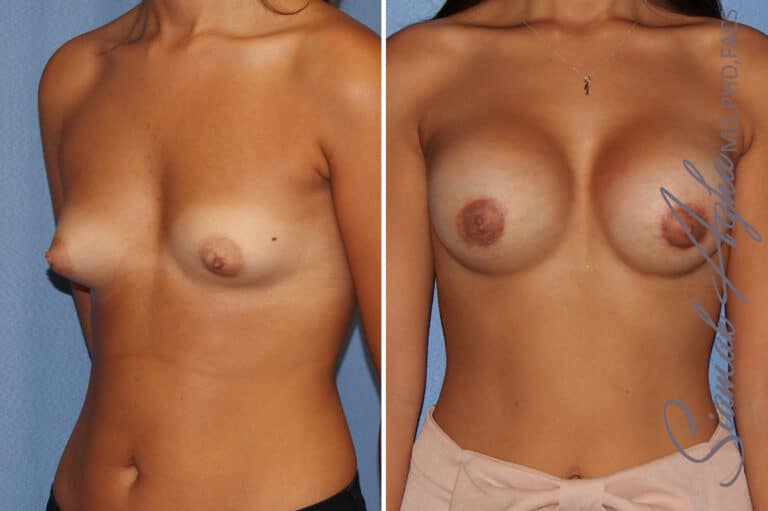 Breast Augmentation