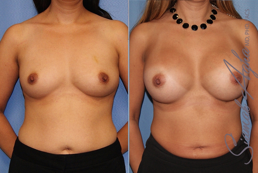 Breast Augmentation