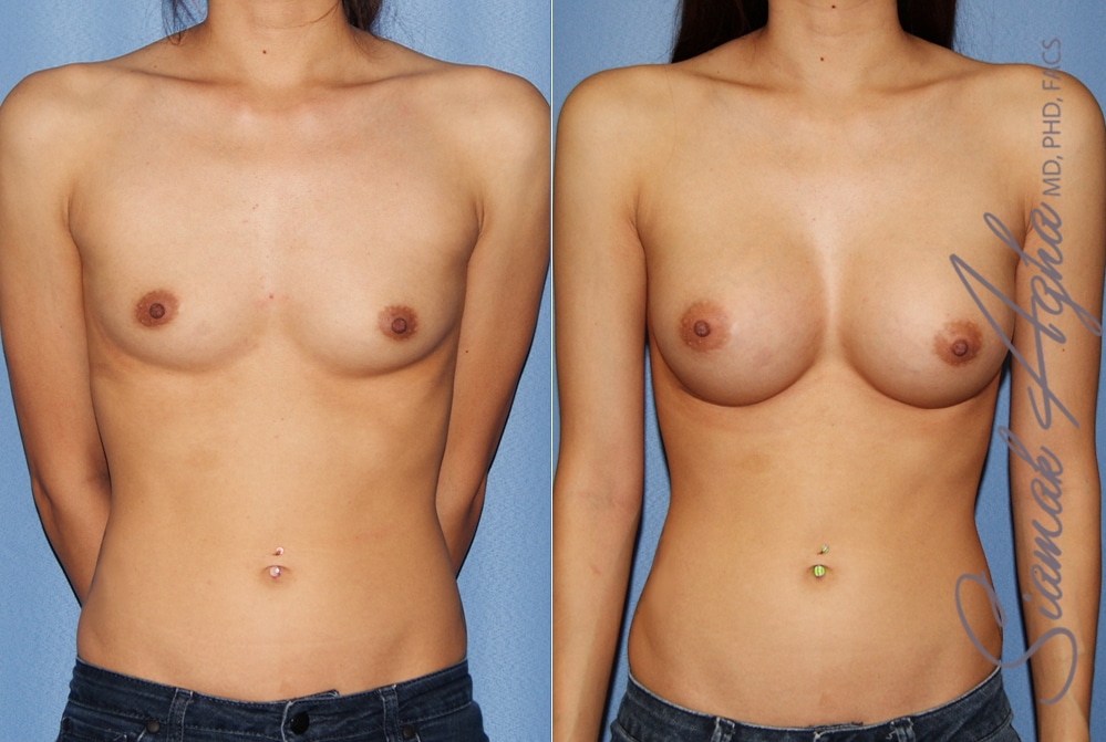 Breast Augmentation