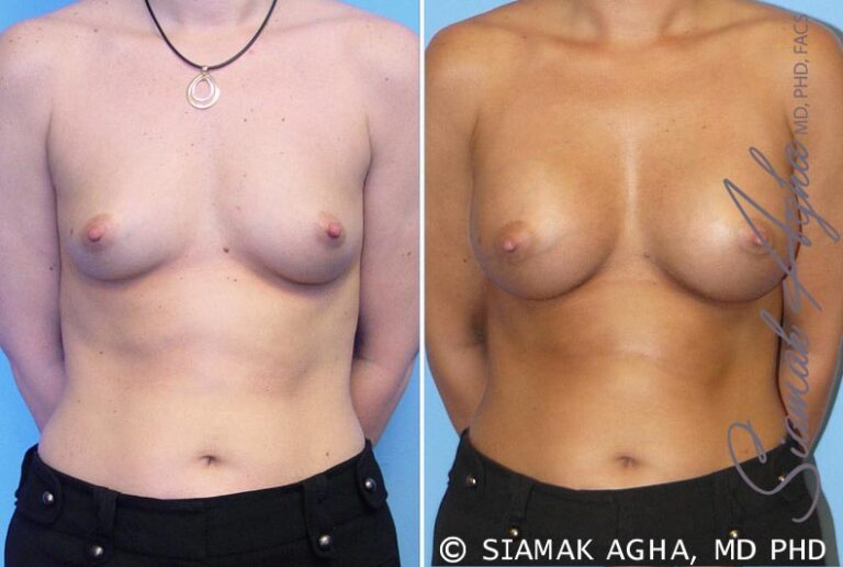 Breast Augmentation