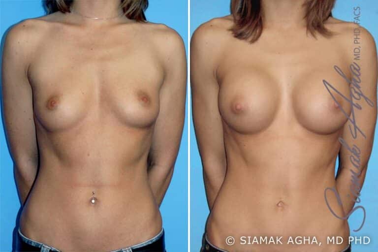 Breast Augmentation