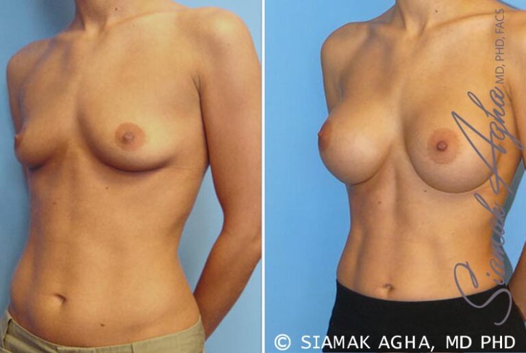 Breast Augmentation