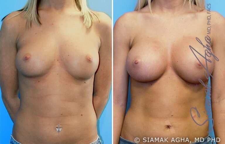 Breast Augmentation