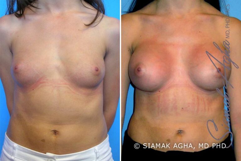 Breast Augmentation