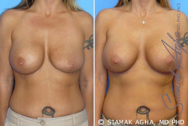 Breast Augmentation Revision