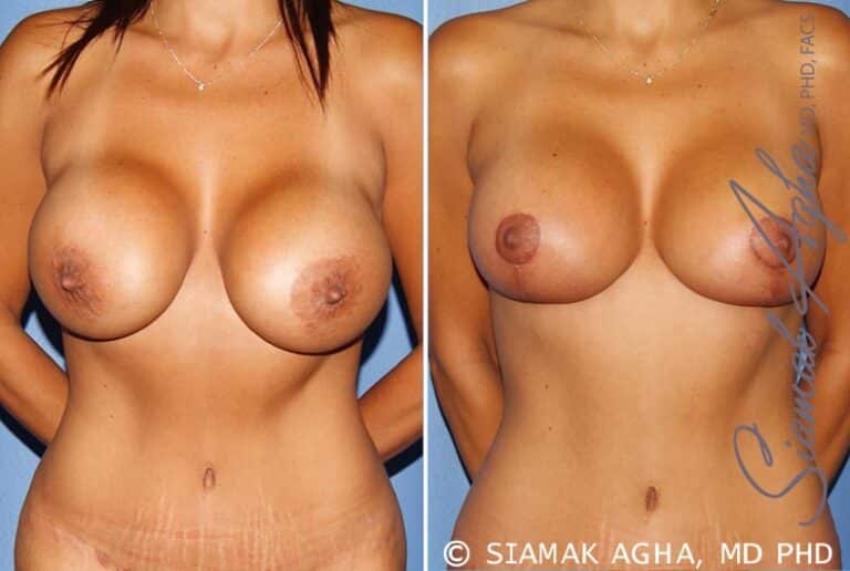 Breast Augmentation Revision