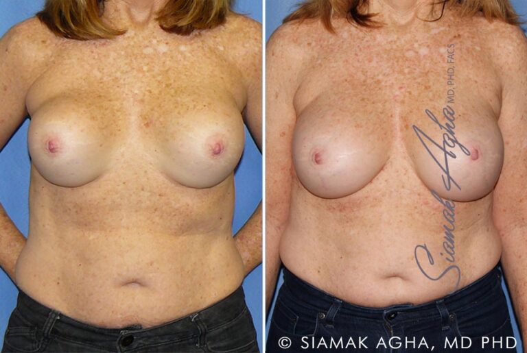 Breast Augmentation Revision