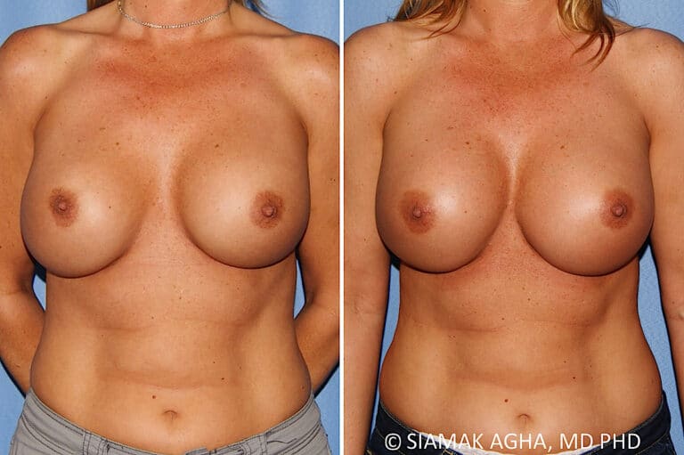 Breast Augmentation Revision