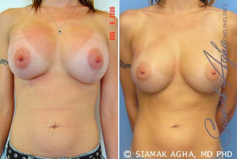 Breast Augmentation Revision