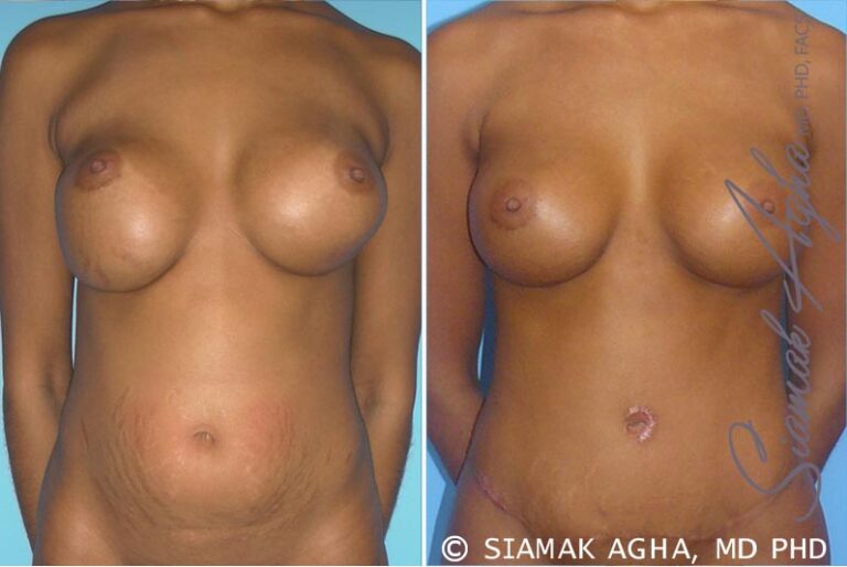 Breast Augmentation Revision