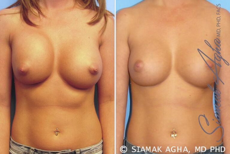 Breast Augmentation Revision