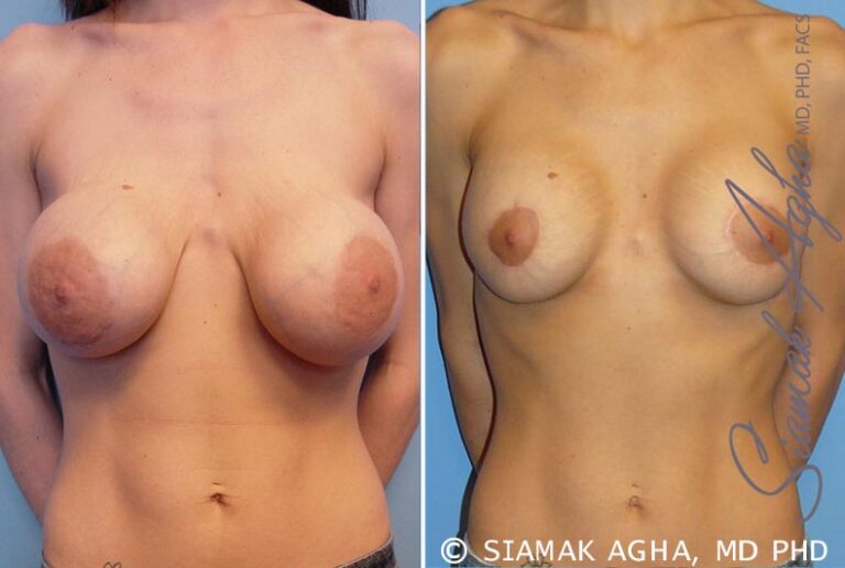 Breast Augmentation Revision