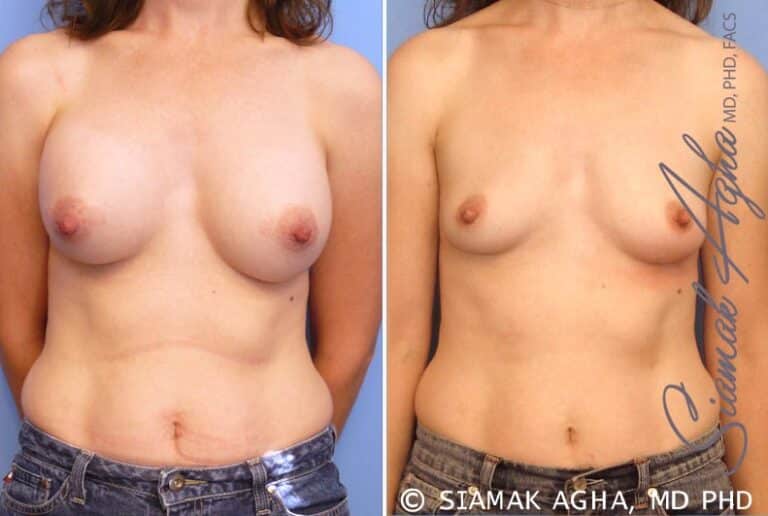 Breast Augmentation Revision