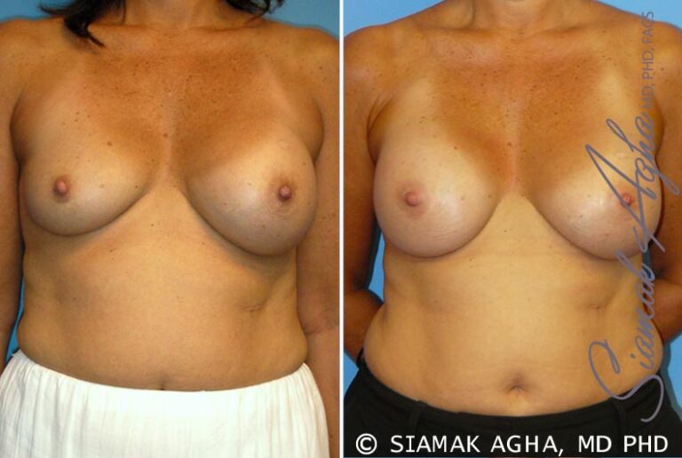 Breast Augmentation Revision