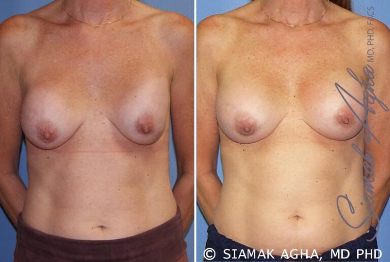 Breast Augmentation Revision