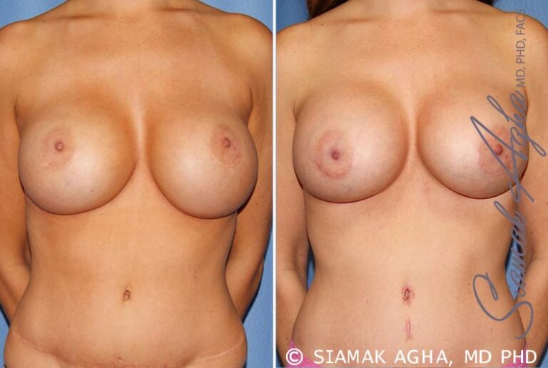 Breast Augmentation Revision